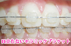 目立たないセラミックブラケット
