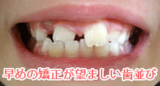 早めの矯正が望ましい歯並び